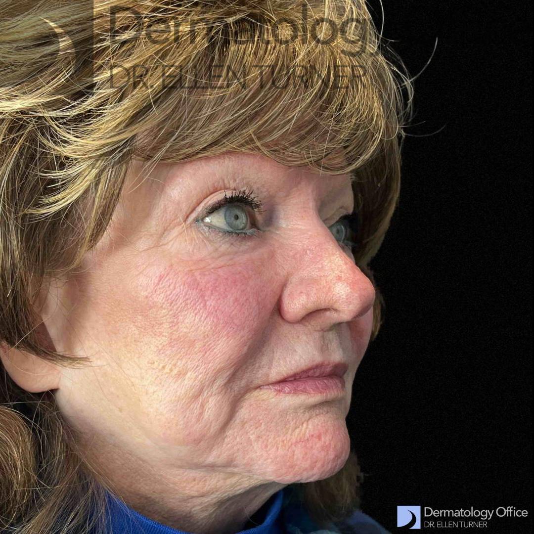 EMFACE (4 treatments) Before and After Case-38 Before