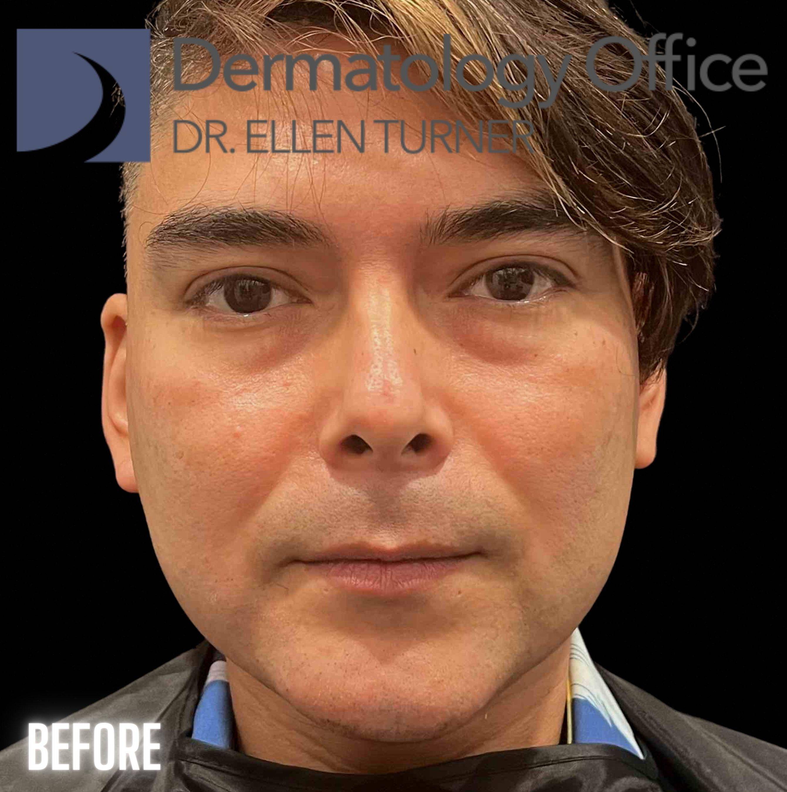 Volux (4 syringes) Before and After Case -13 Before