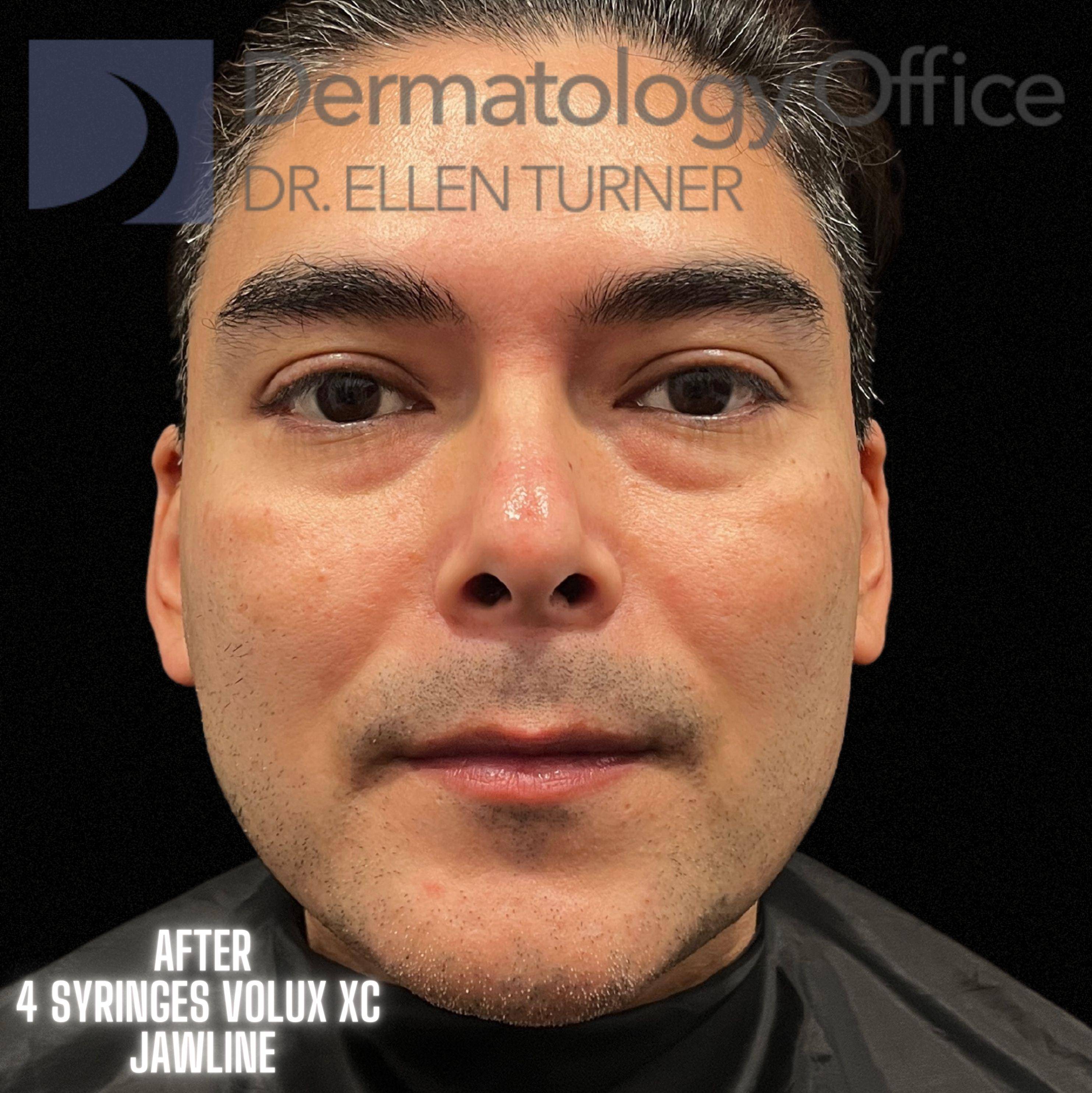 Volux (4 syringes) Before and After Case -13 After