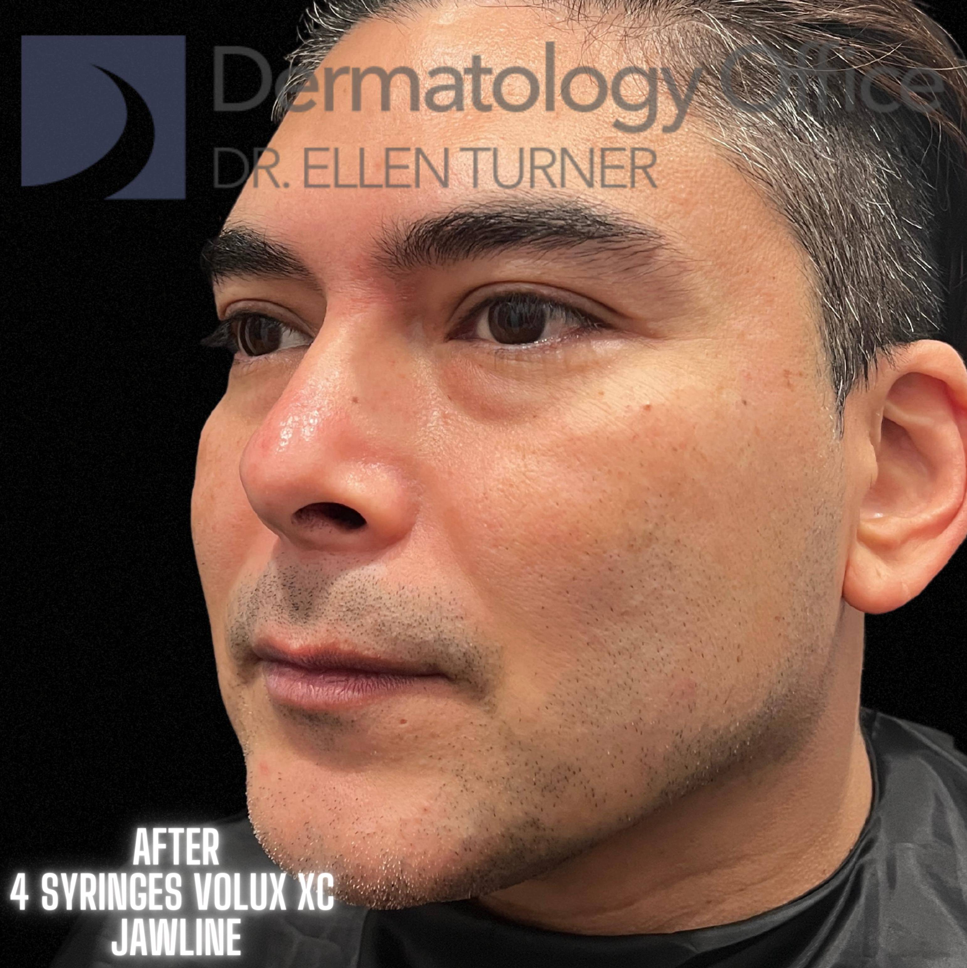 Volux (4 syringes) Before and After Case -14 After