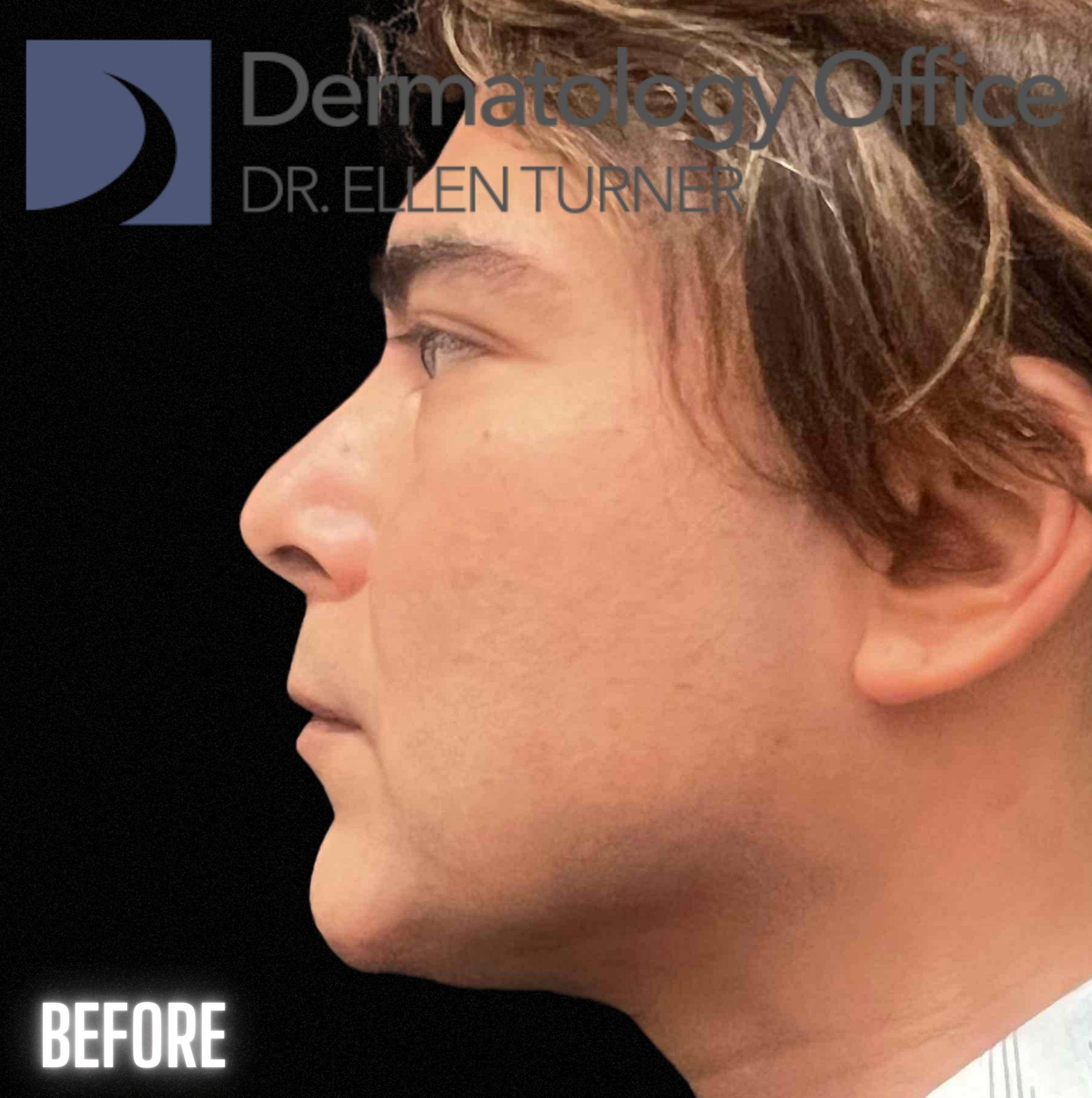 Volux (4 syringes) Before and After Case -15 Before