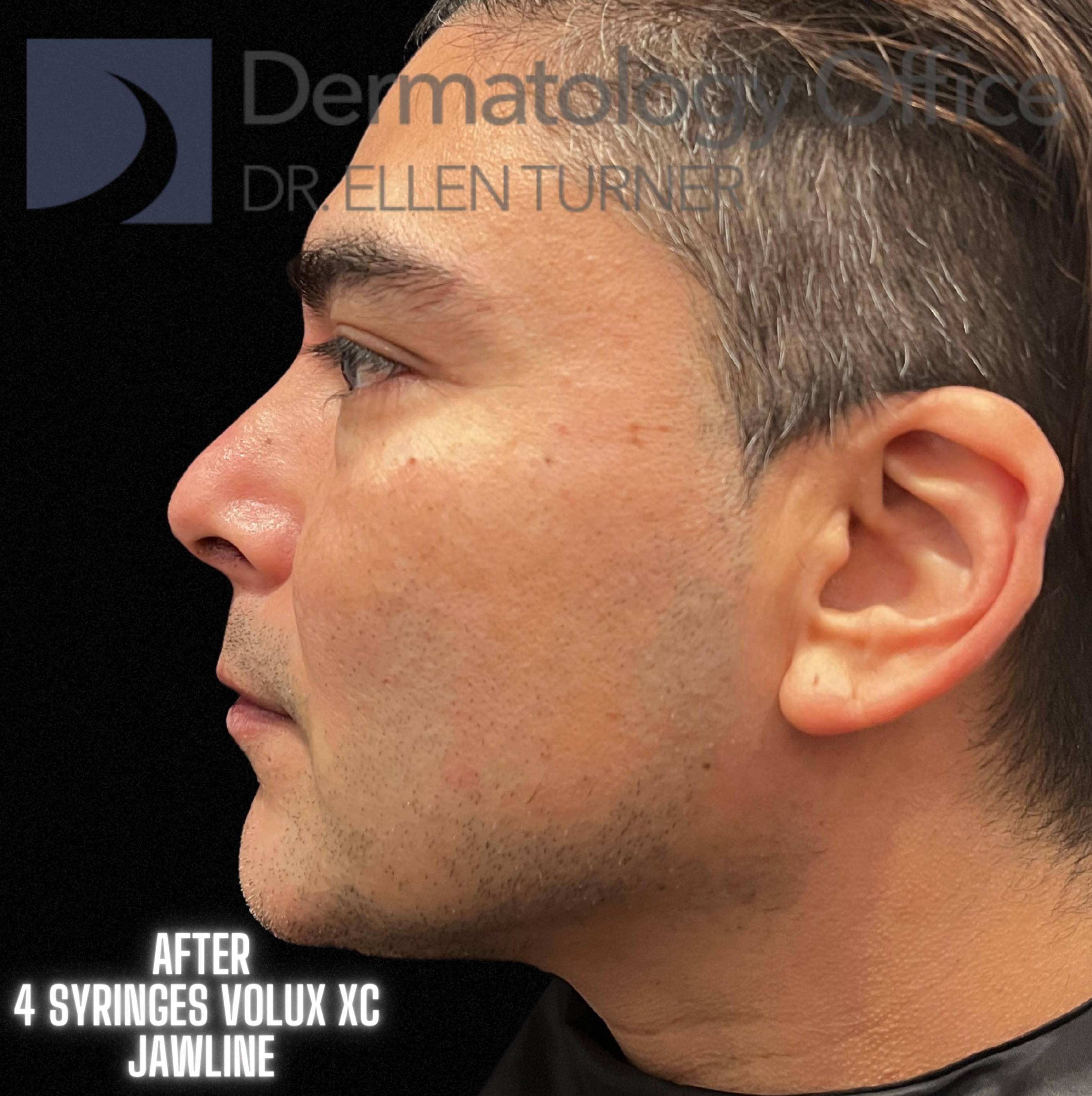 Volux (4 syringes) Before and After Case -15 After