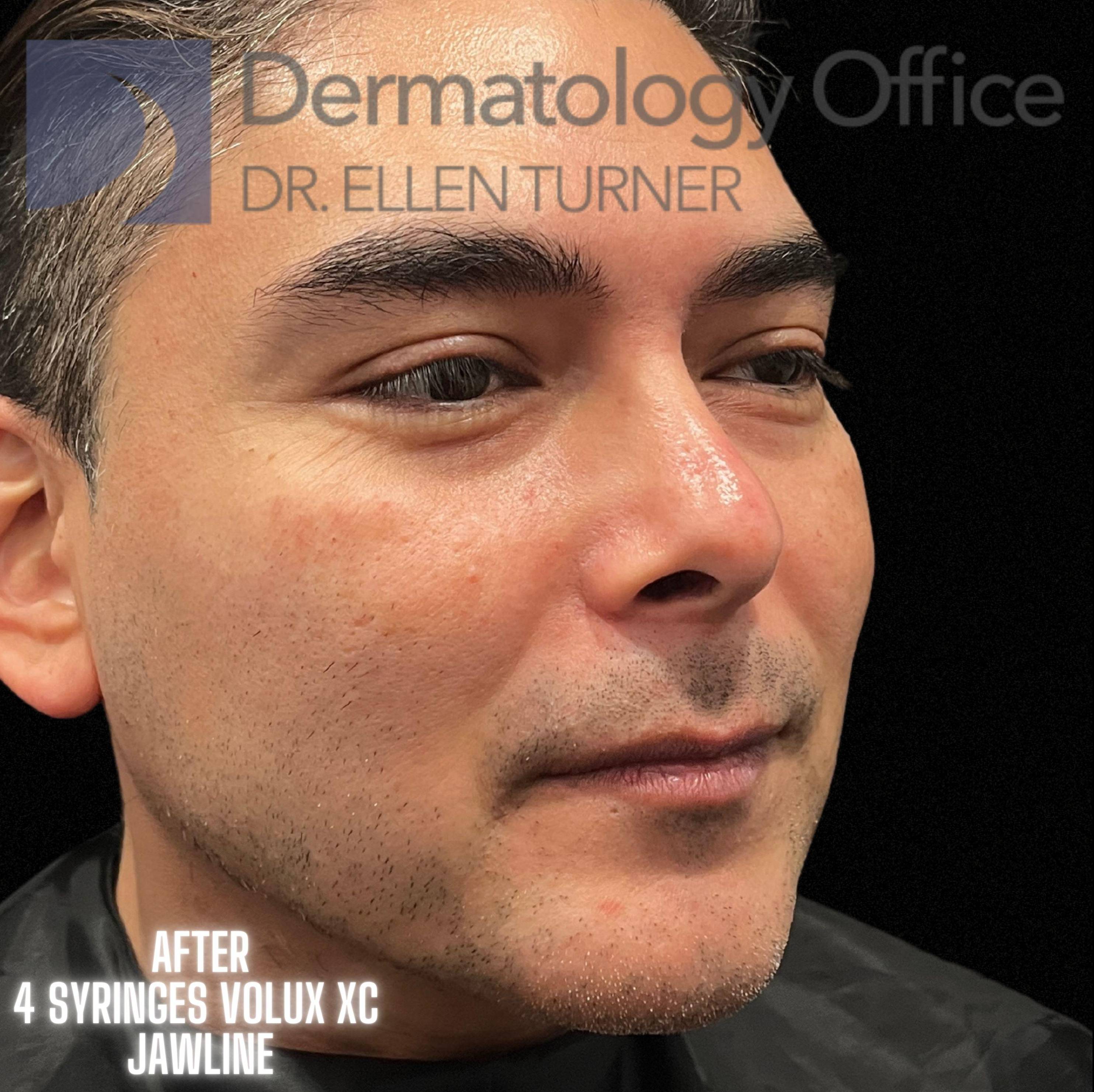 Volux (4 syringes) Before and After Case -16 After