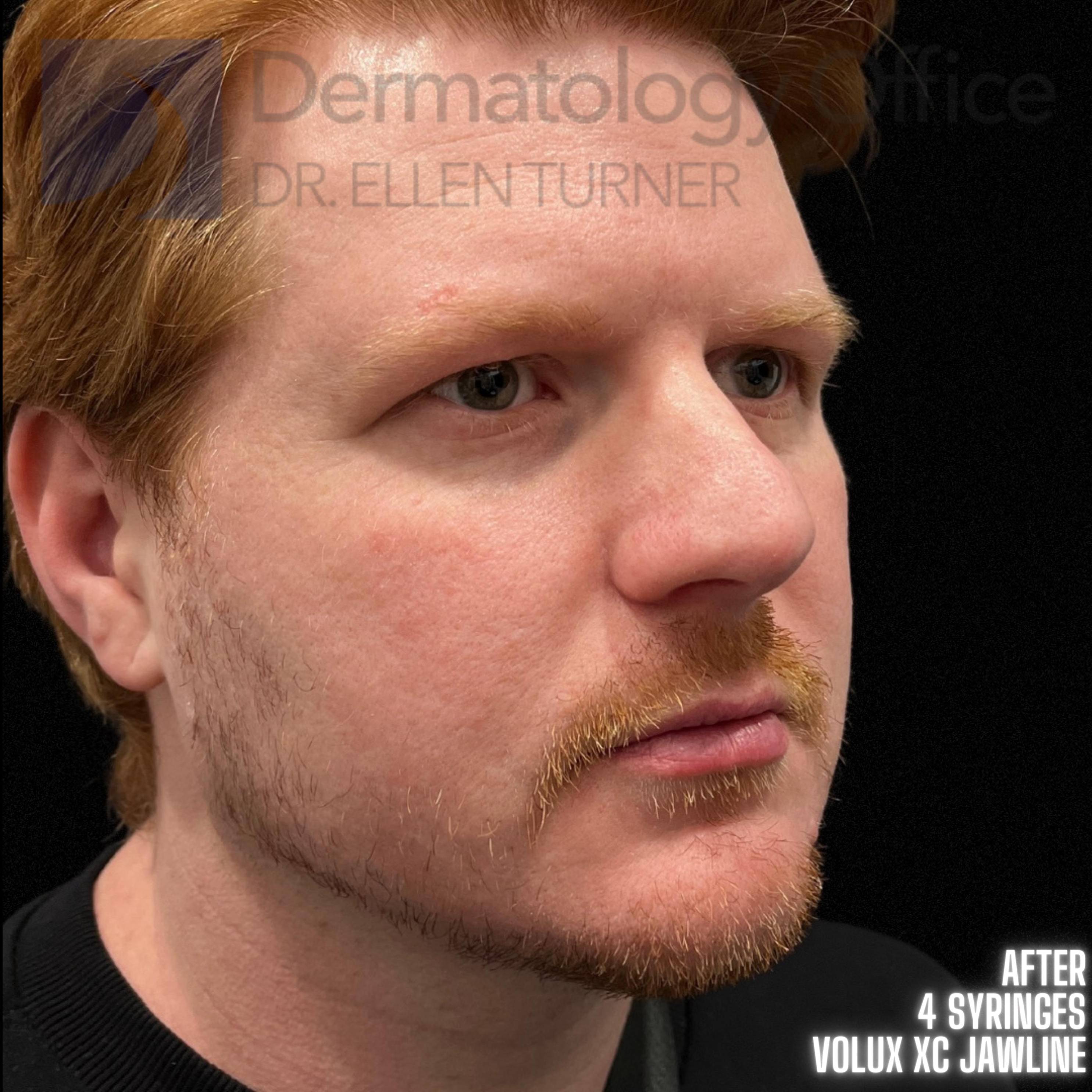 Volux (4 syringes) Before and After Case -20 After
