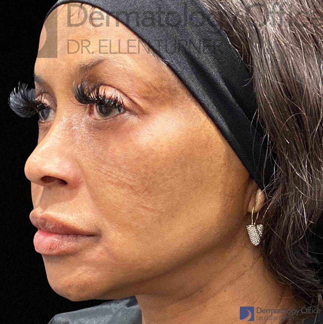 EMFACE (4 treatments) Before and After Case-18 Before