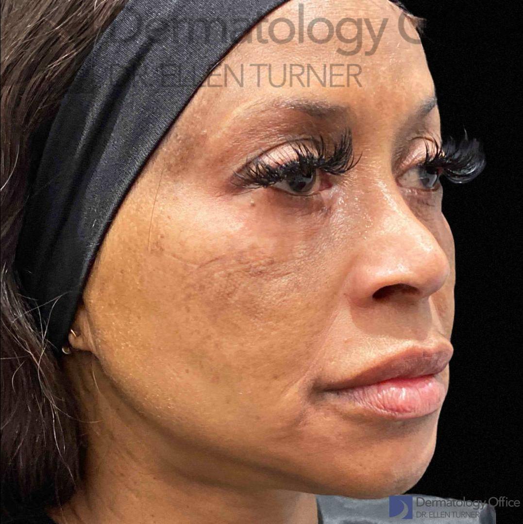 EMFACE (4 treatments) Before and After Case-19 Before