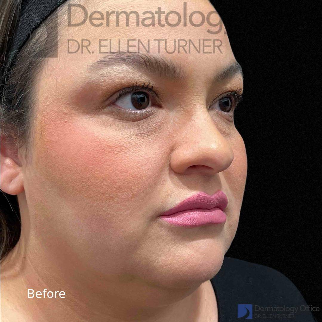 Kybella (2 vials) Case-7 Before