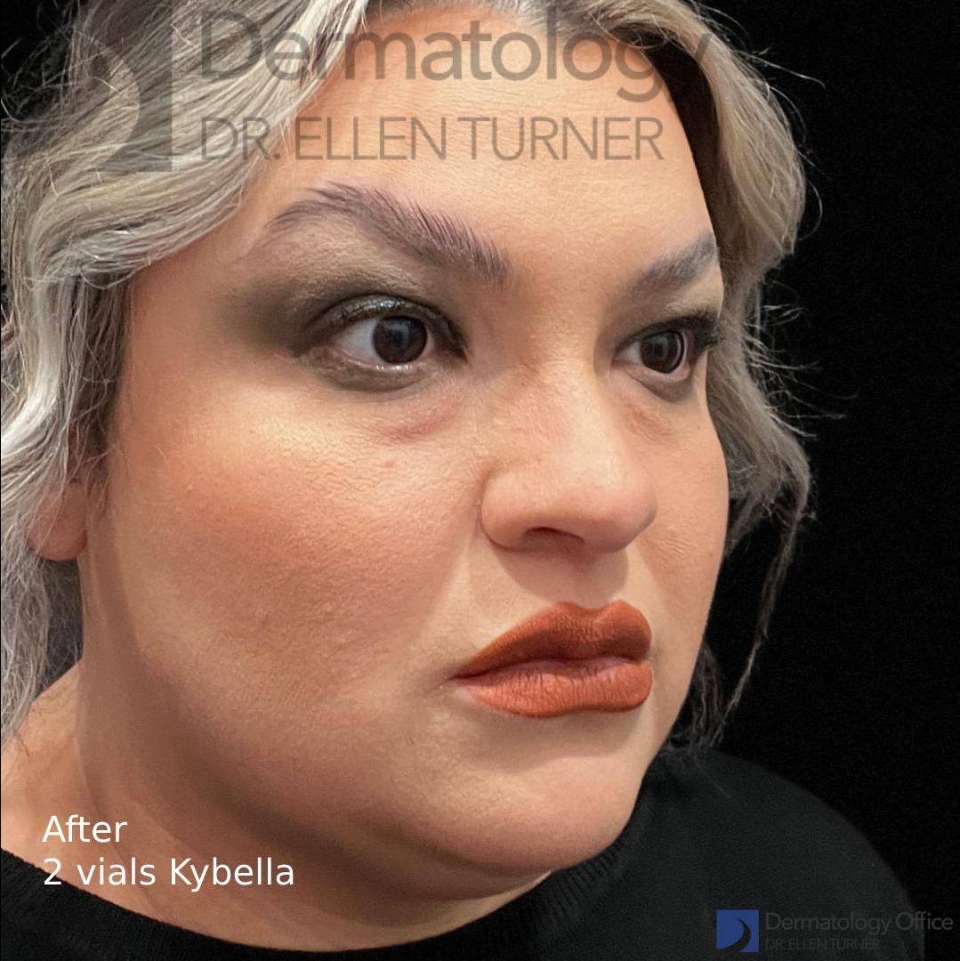 Kybella (2 vials) Case-7 After