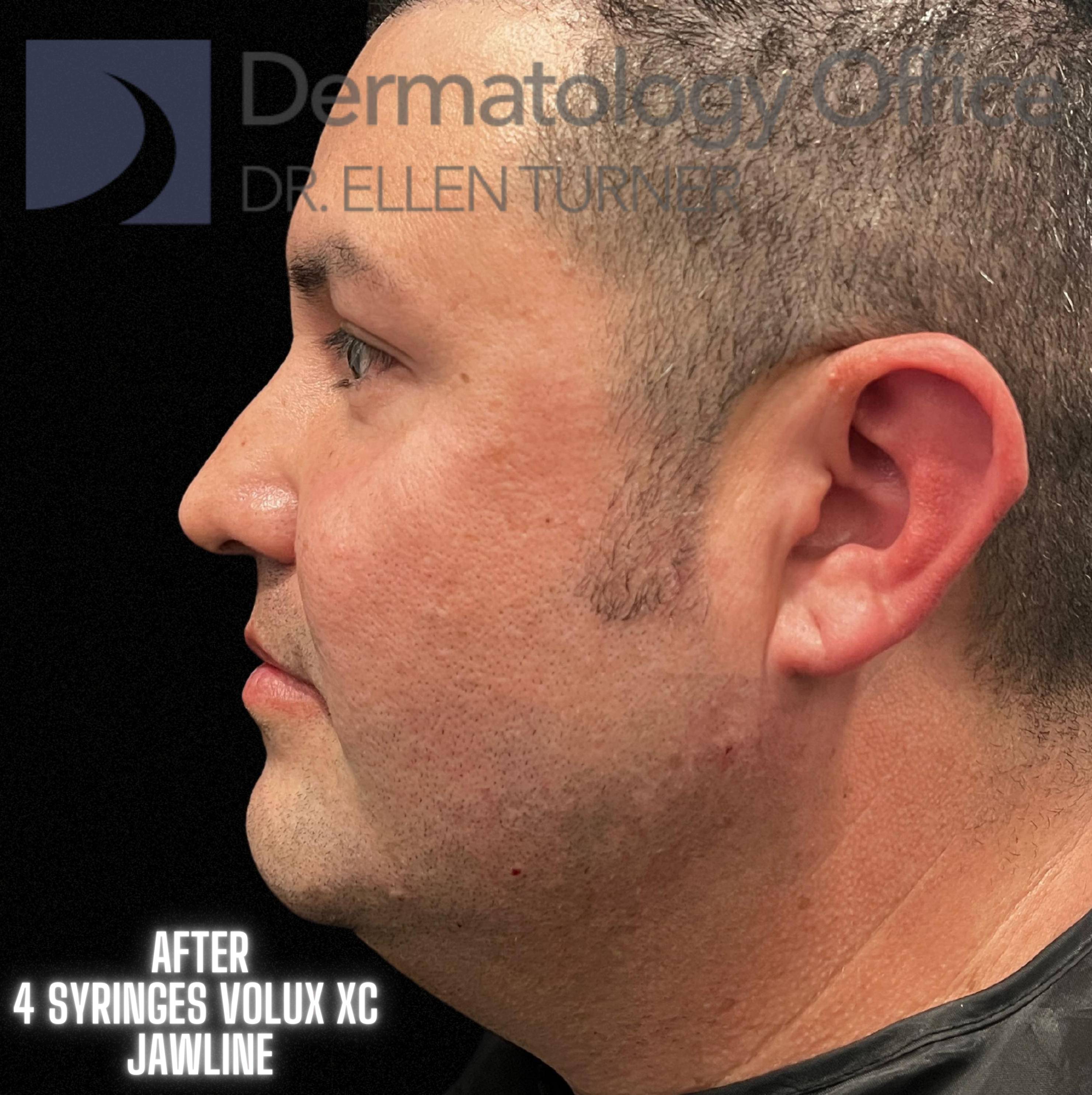 Volux (4 syringes) Before and After Case -23 After