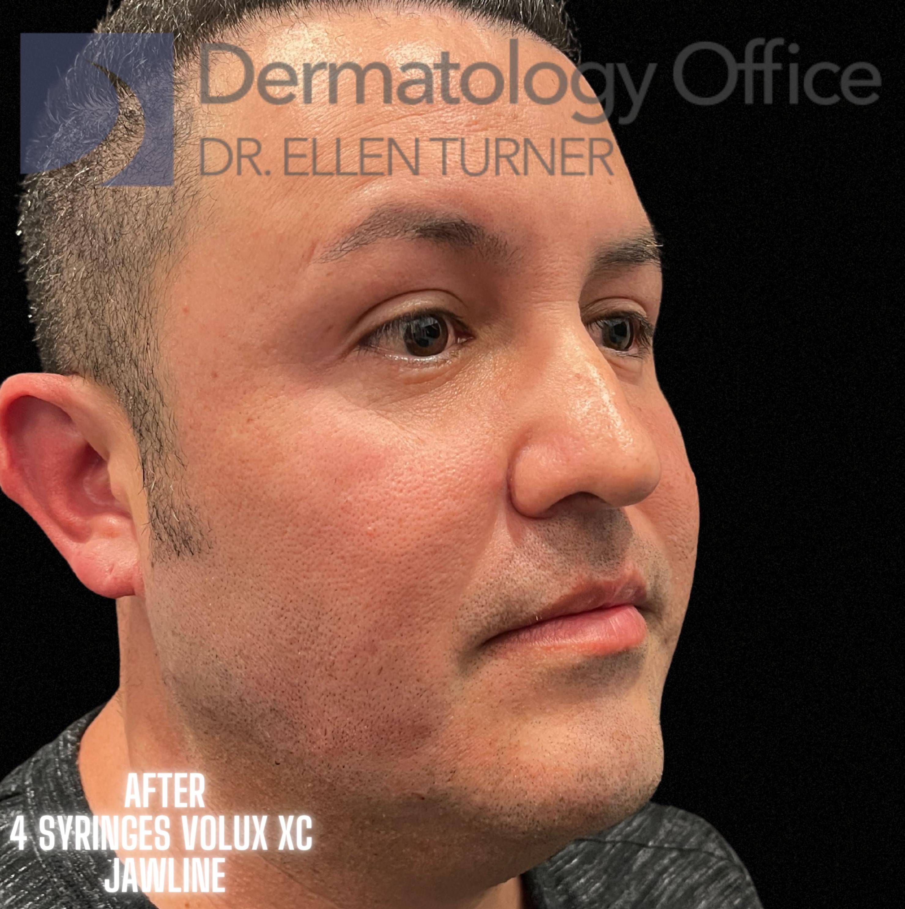 Volux (4 syringes) Before and After Case -24 After