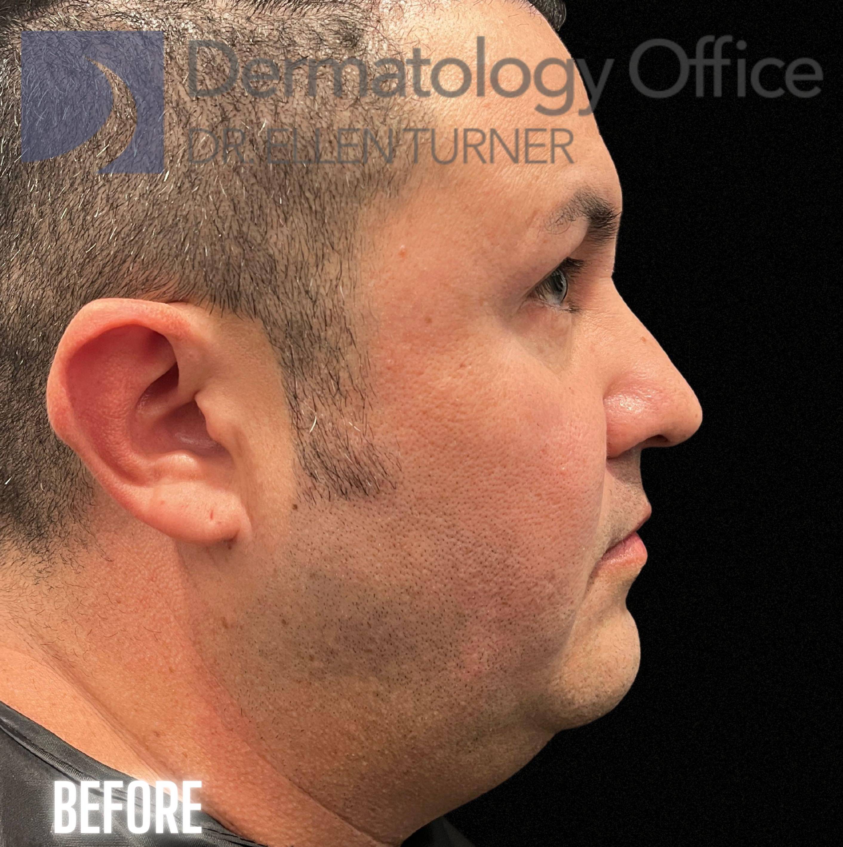 Volux (4 syringes) Before and After Case -25 Before