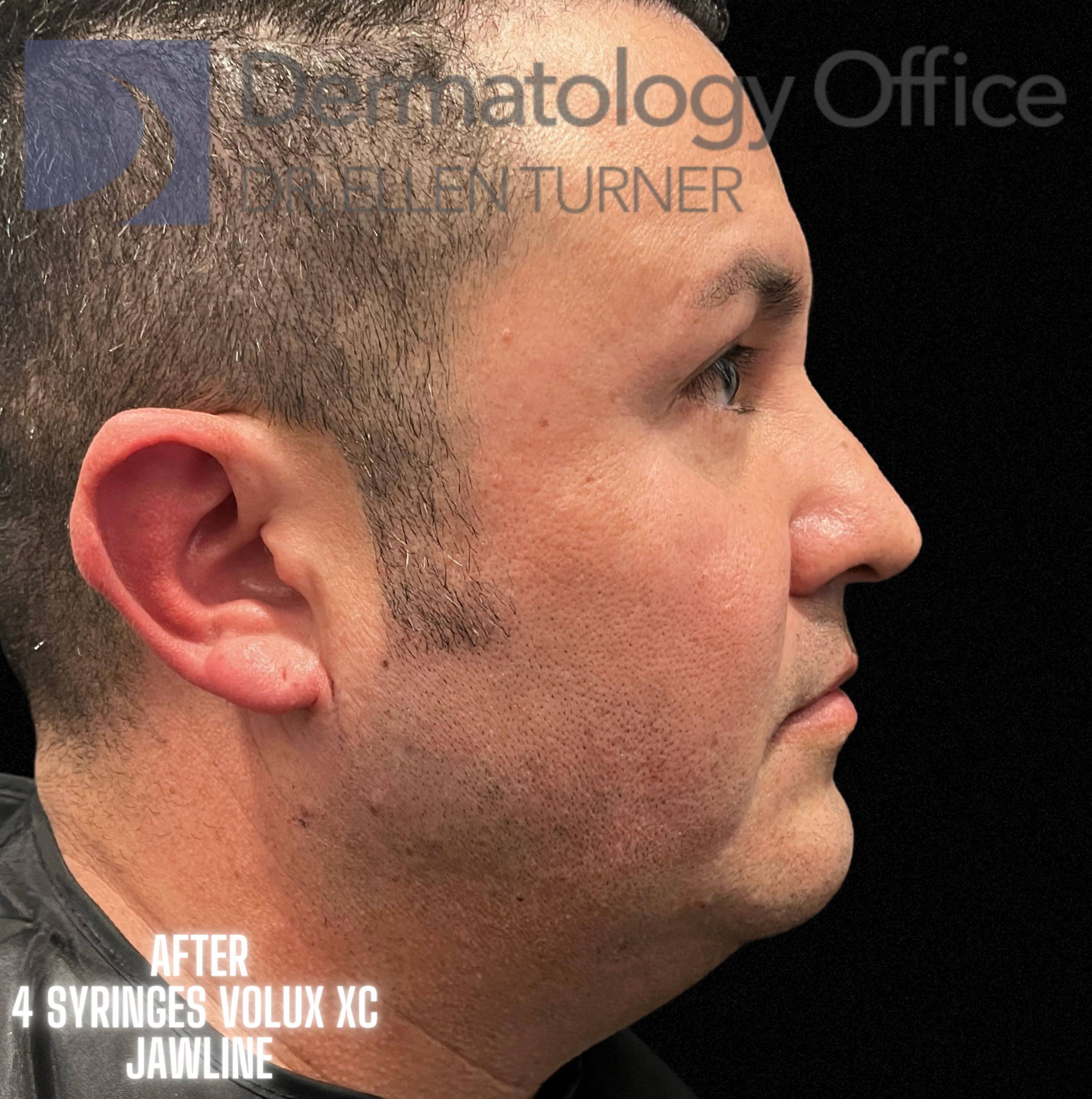 Volux (4 syringes) Before and After Case -25 After