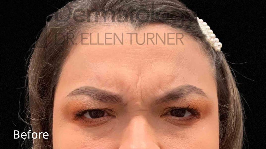 Xeomin (25 Units Glabella) Case-9 Before