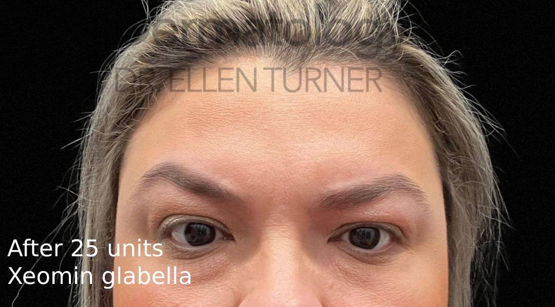 Xeomin (25 Units Glabella) Case-9 After