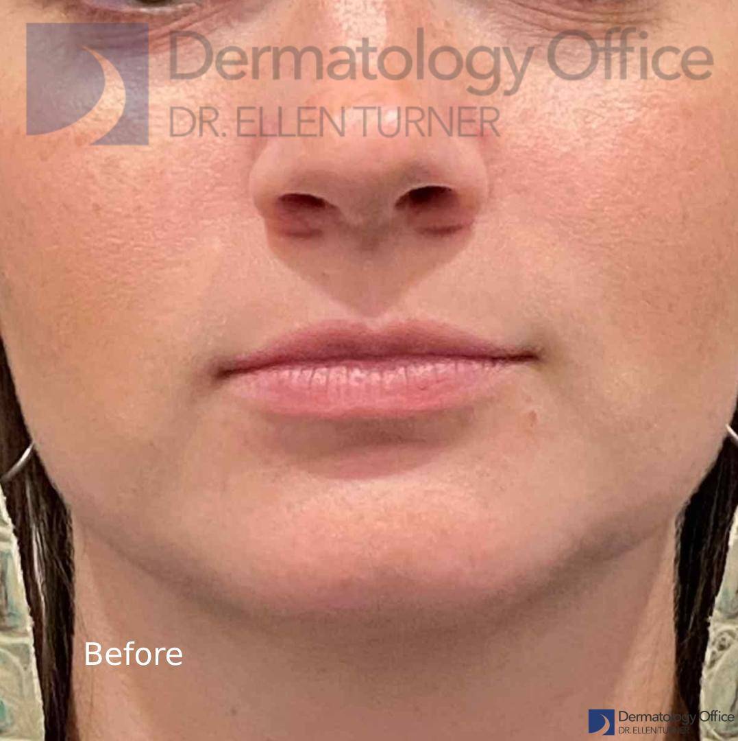 Juvederm (1 Syringe) Case-33 Before