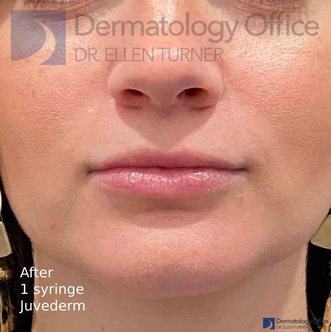 Juvederm (1 Syringe) Case-33 After