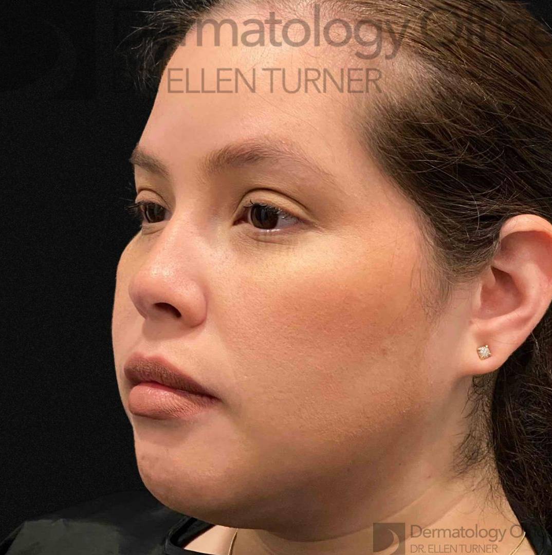 EMFACE (1 treatment) Before and After Case-42 Before