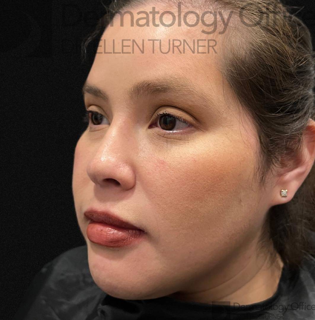 EMFACE (1 treatment) Before and After Case-42 After