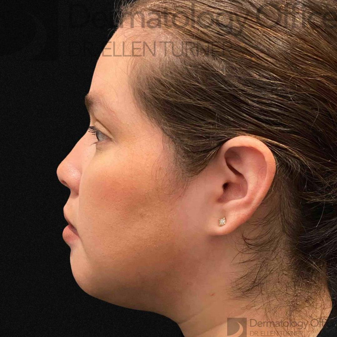 EMFACE (1 treatment) Before and After Case-43 Before