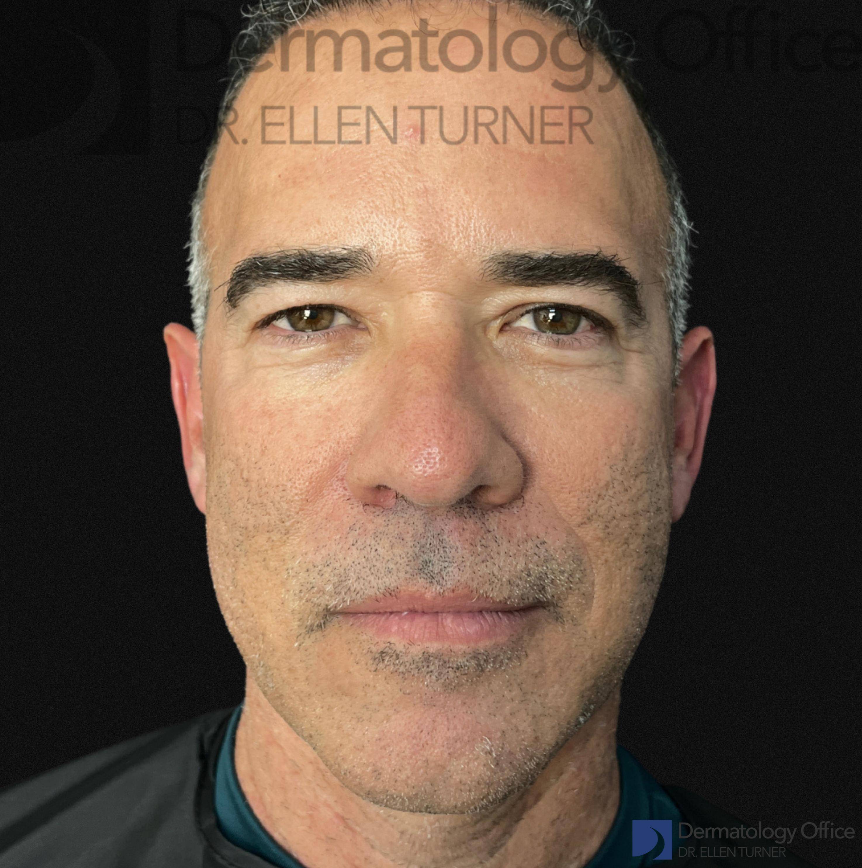 EMFACE (4 treatments) Before and After Case-44 Before