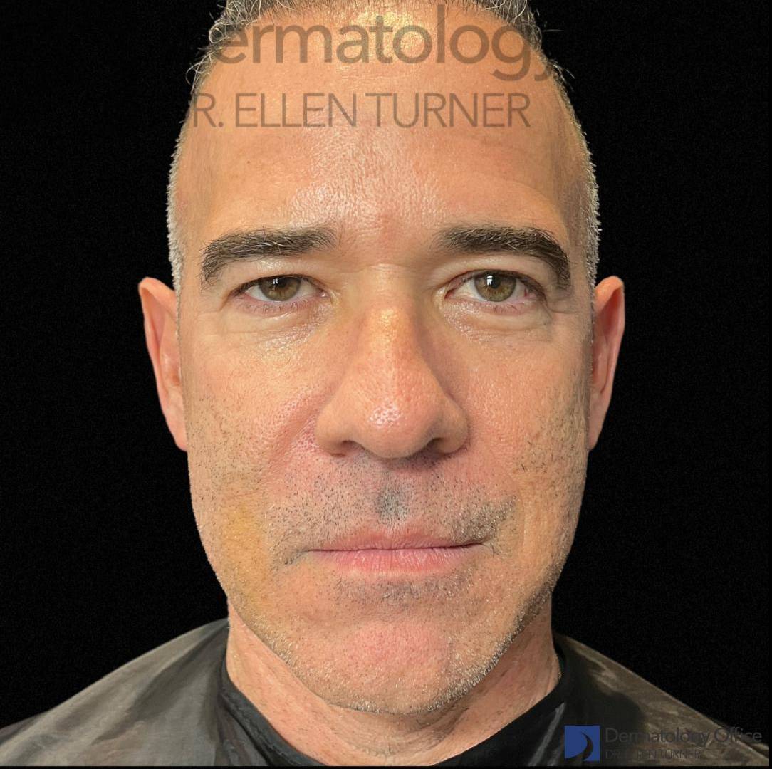 EMFACE (4 treatments) Before and After Case-44 After
