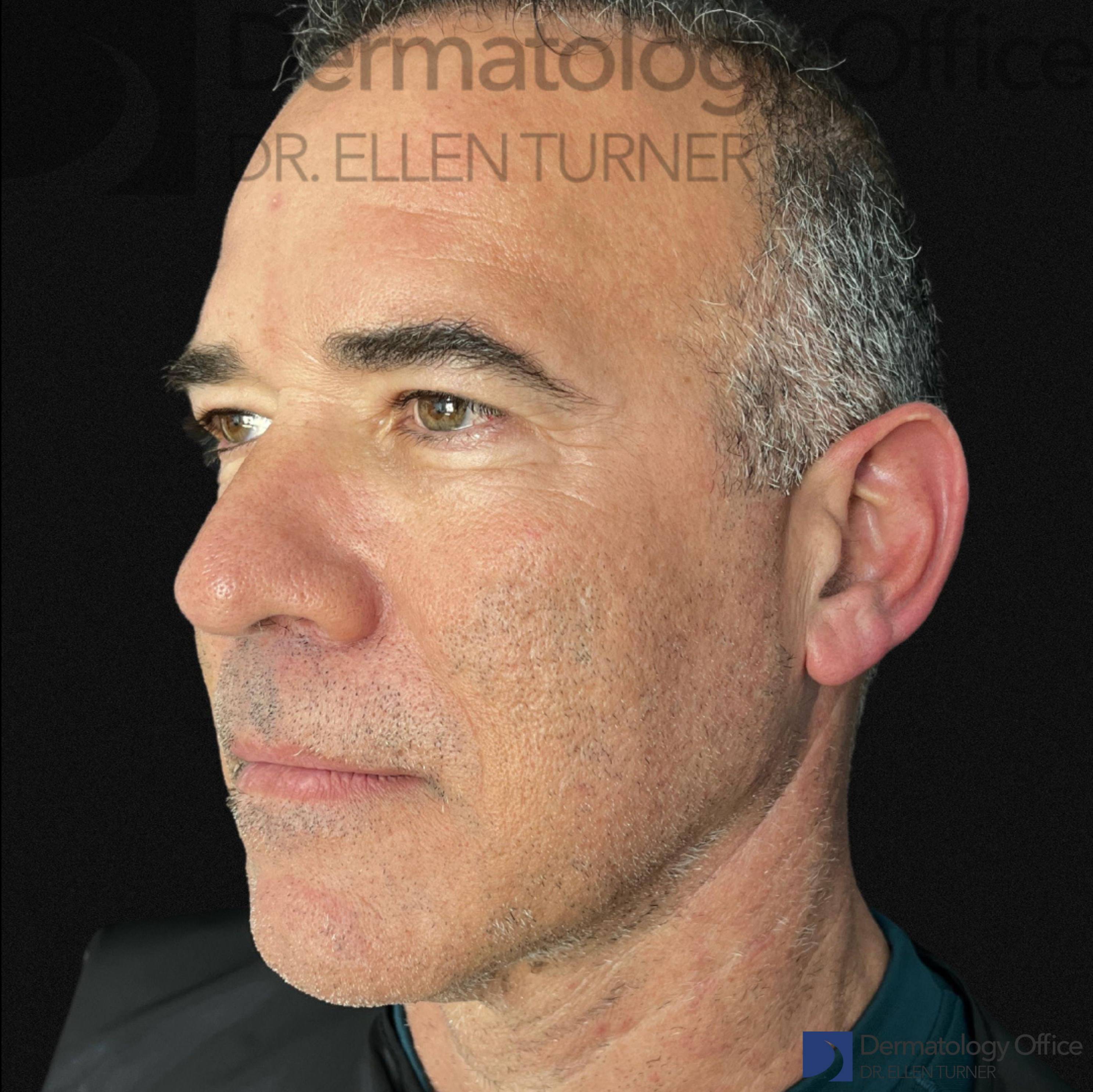 EMFACE (4 treatments) Before and After Case-45 Before