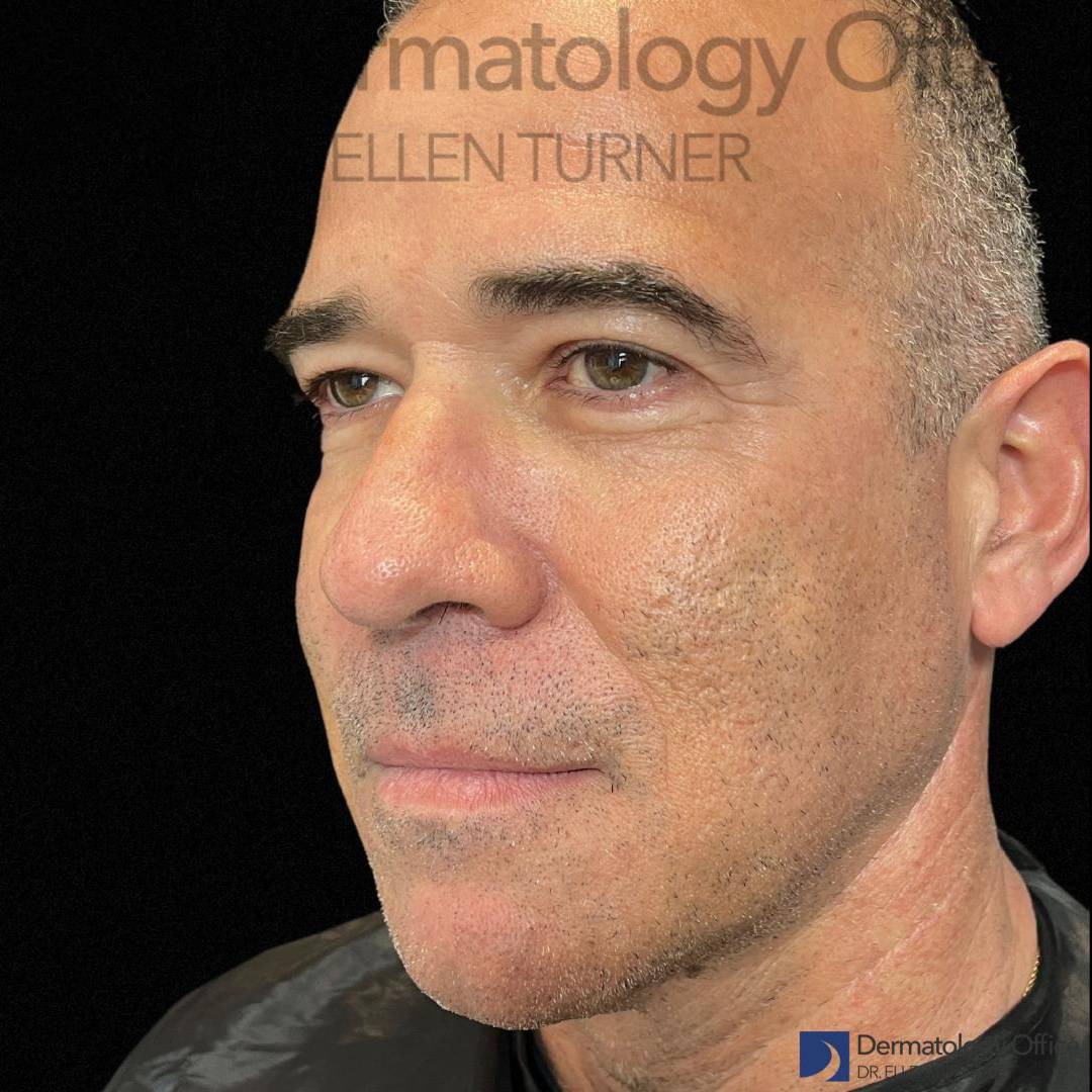 EMFACE (4 treatments) Before and After Case-45 After