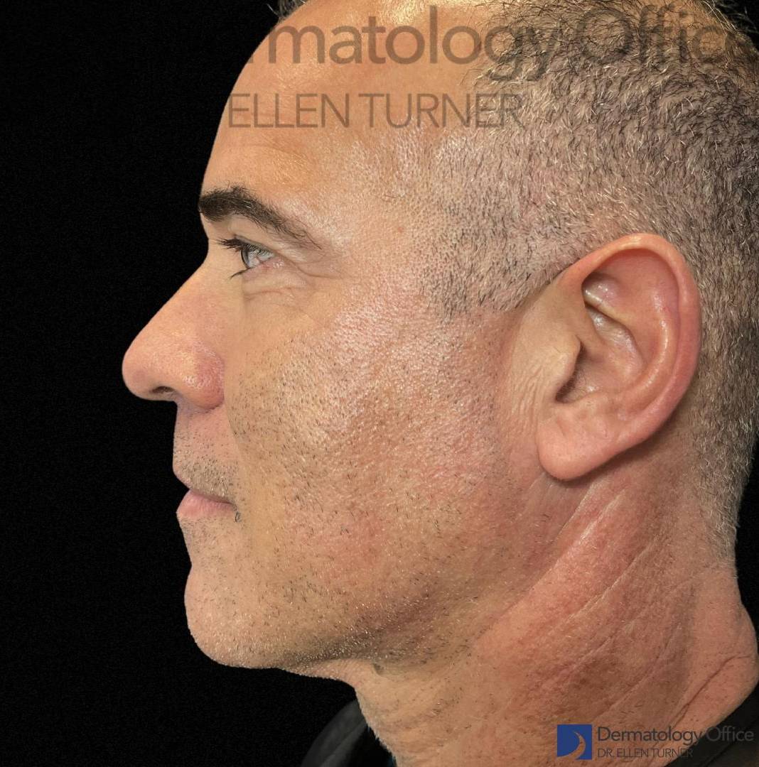 EMFACE (4 treatments) Before and After Case-46 After