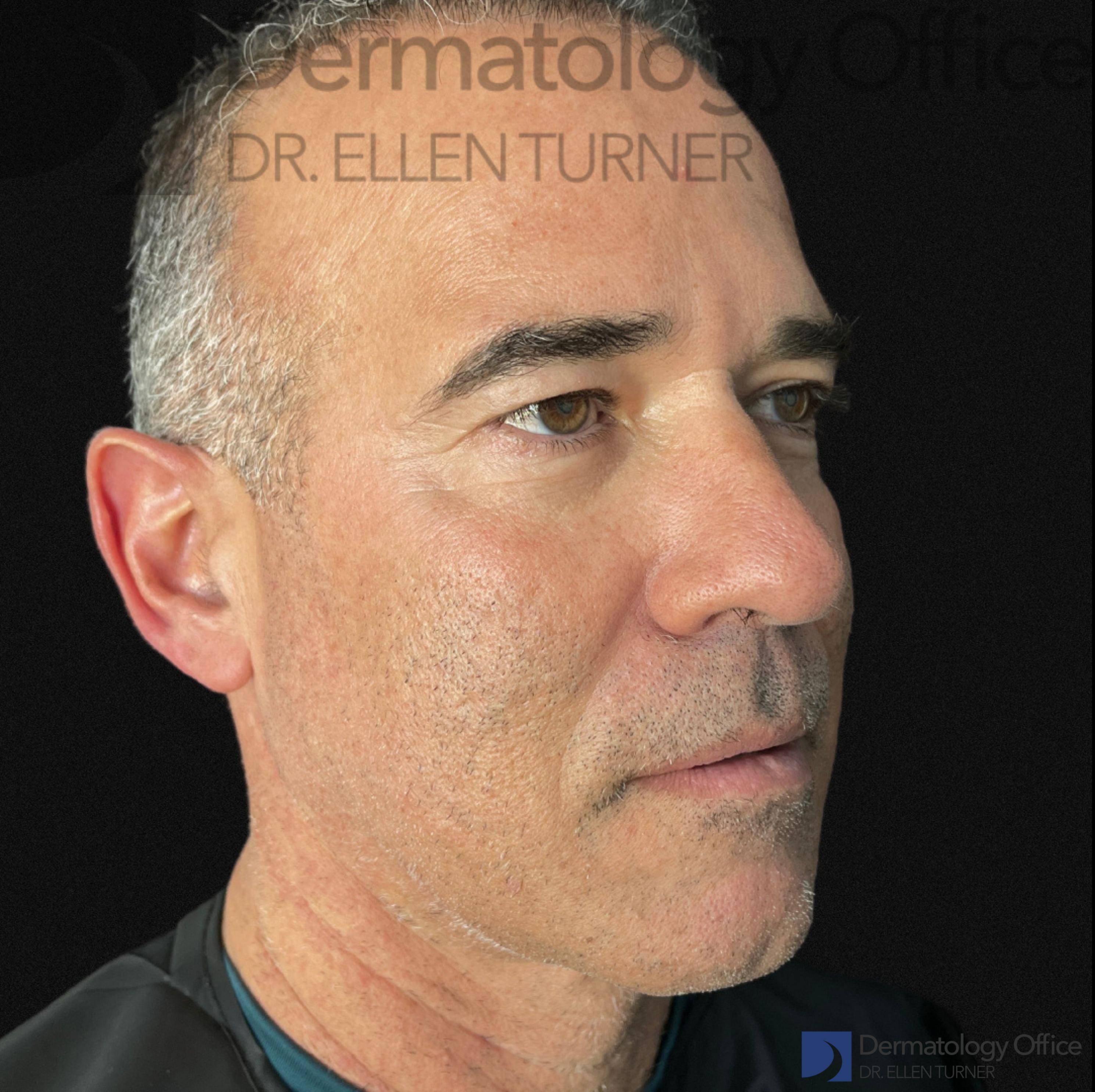 EMFACE (4 treatments) Before and After Case-47 Before