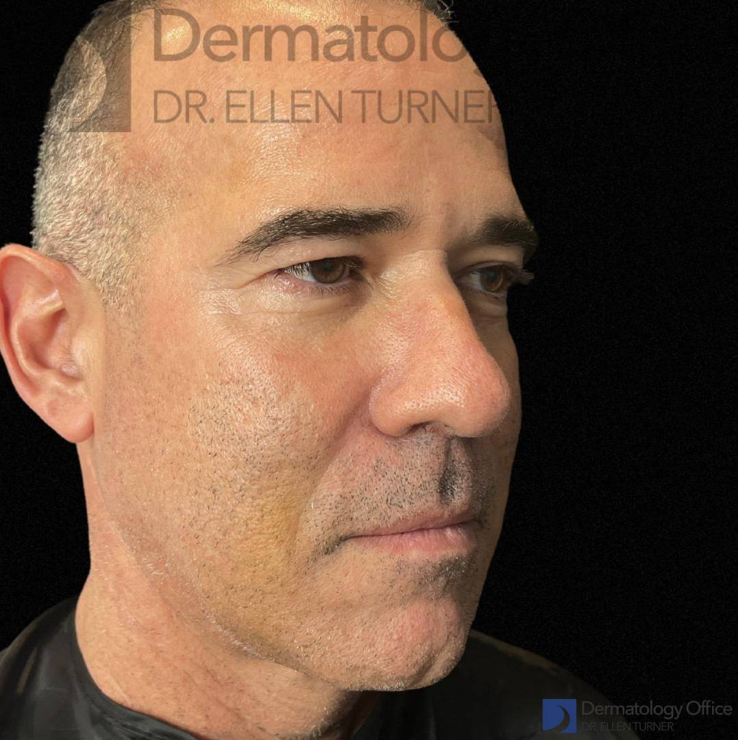 EMFACE (4 treatments) Before and After Case-47 After