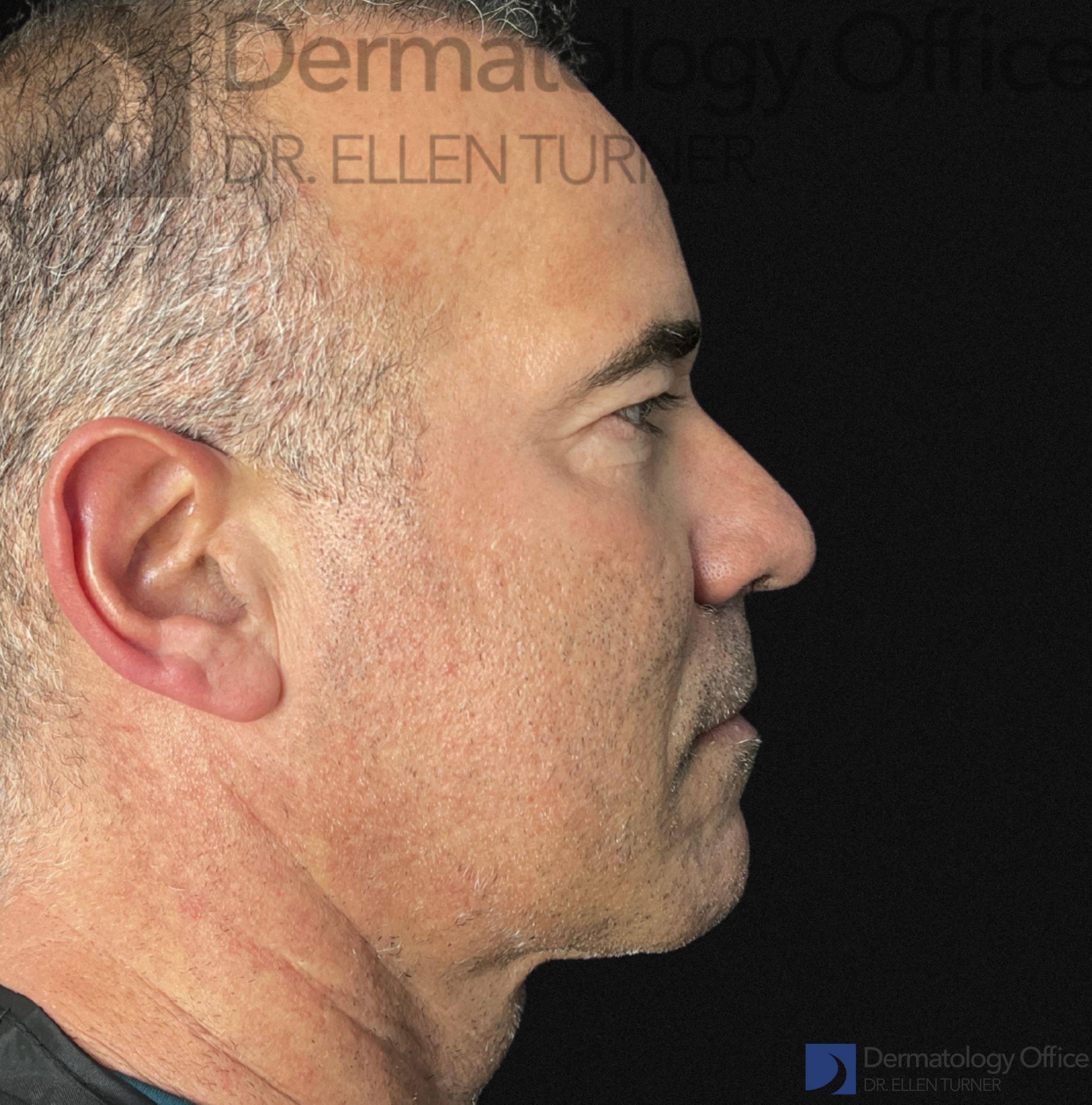EMFACE (4 treatments) Before and After Case-48 Before