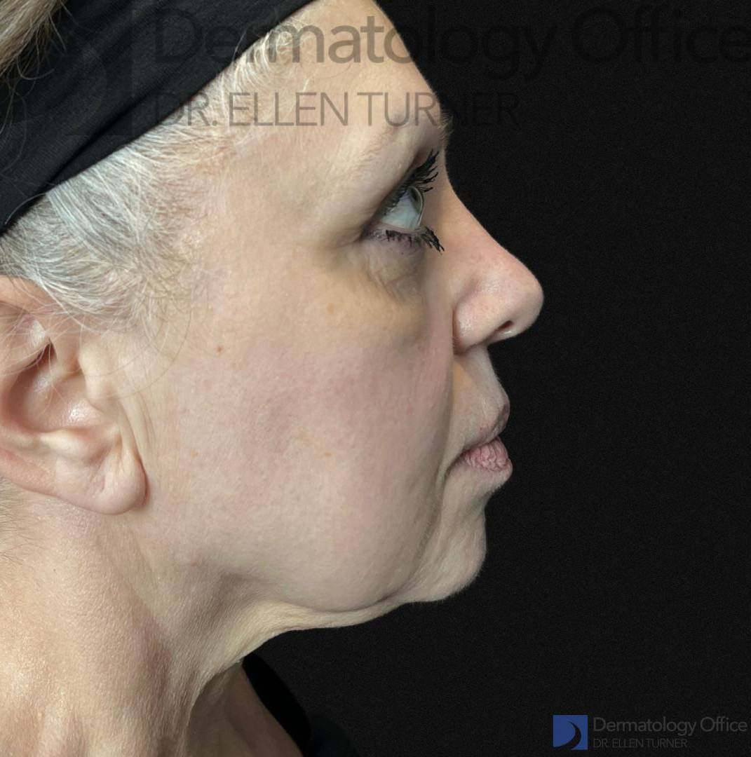 EMFACE (4 treatments) Before and After Case-52 Before