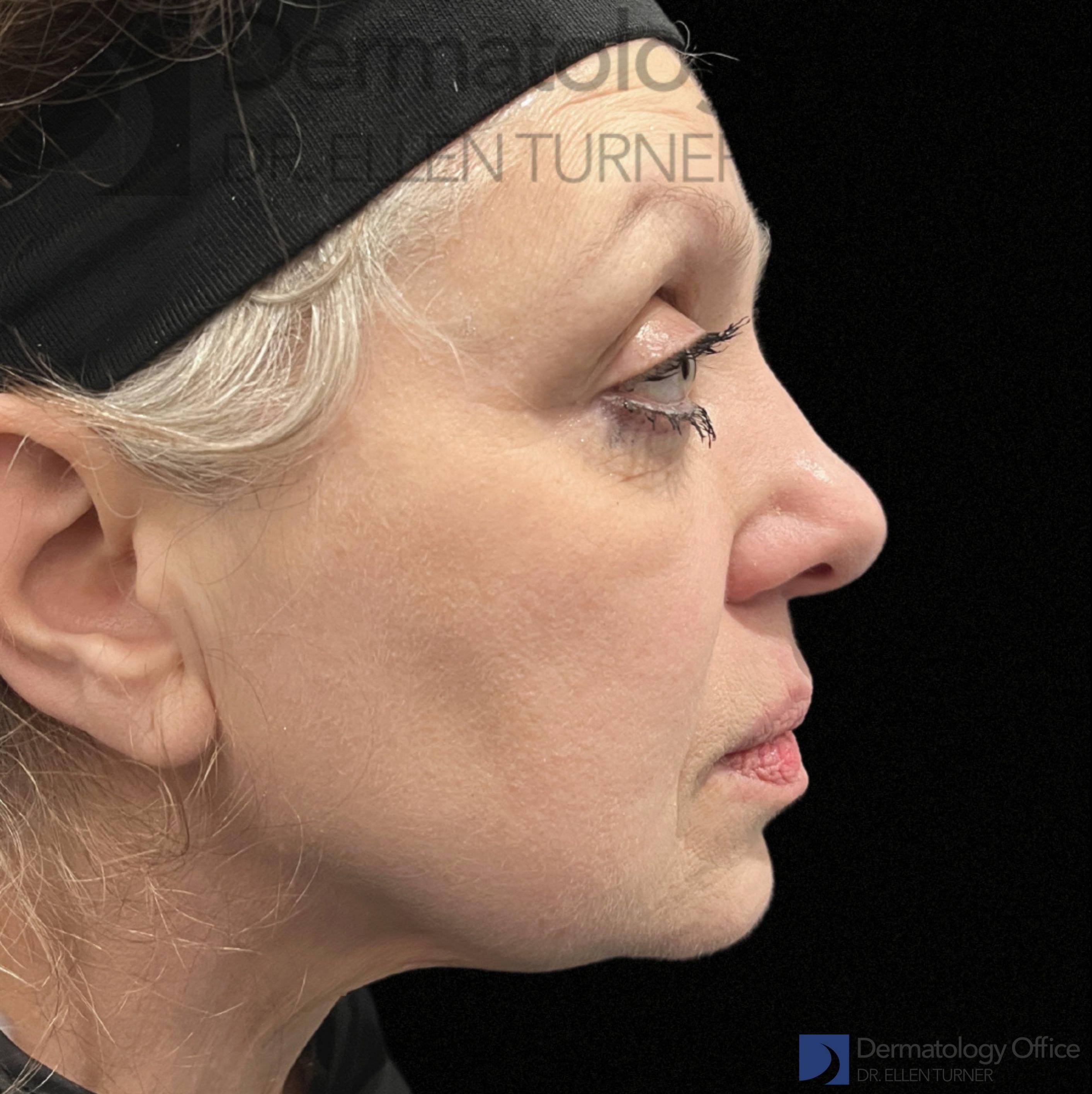 EMFACE (4 treatments) Before and After Case-52 After