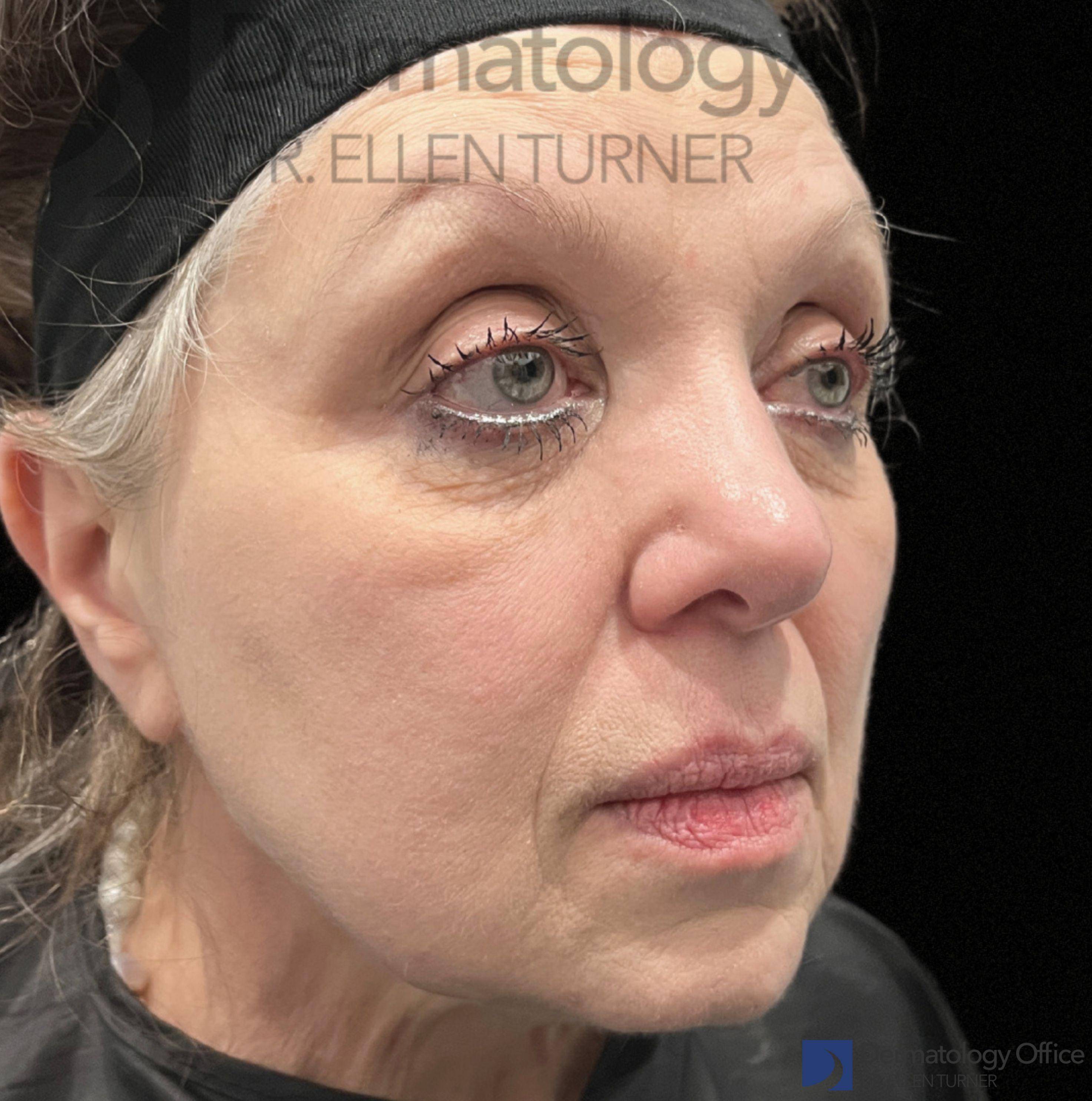 EMFACE (4 treatments) Before and After Case-53 After