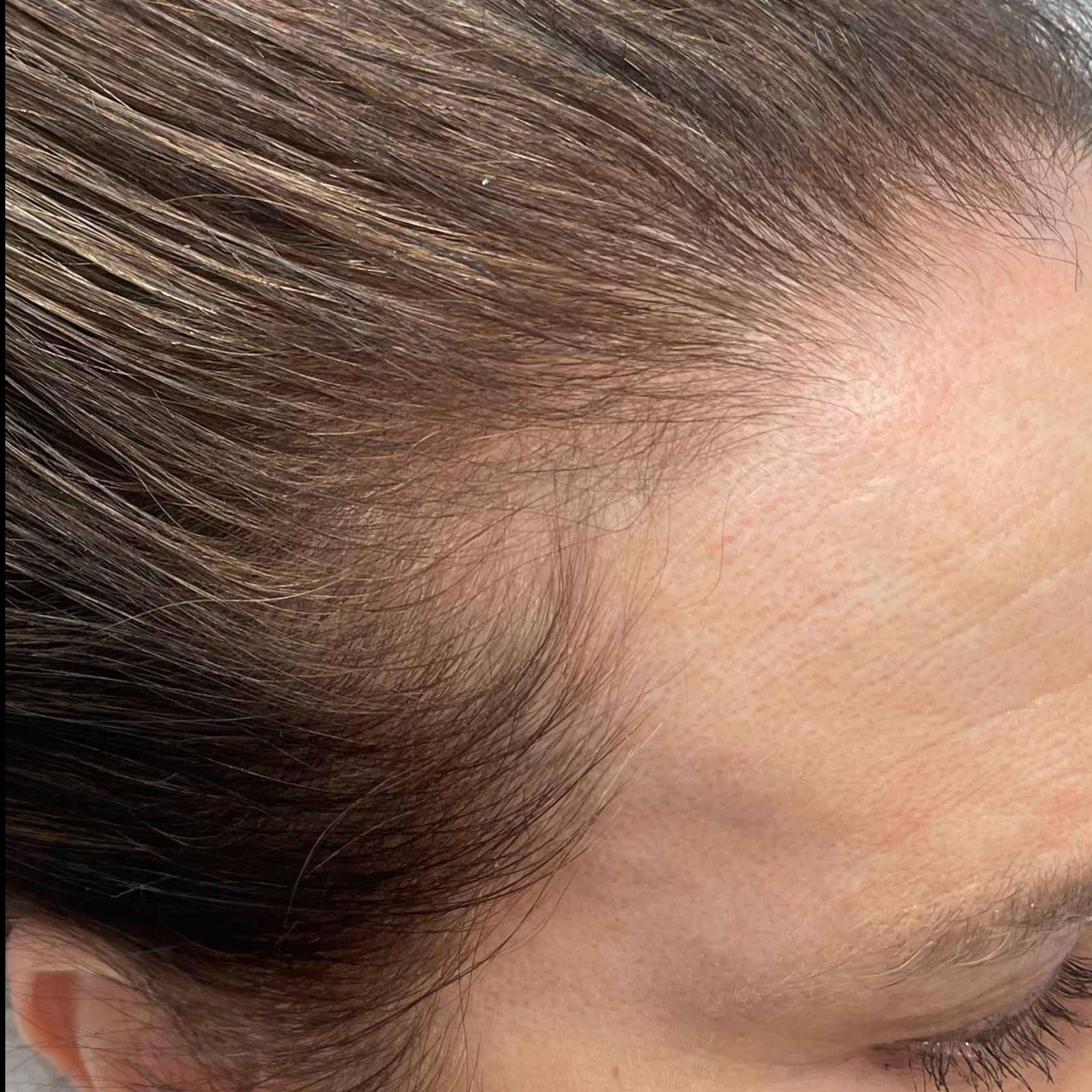 Hair Loss Before and After Case-14 Before