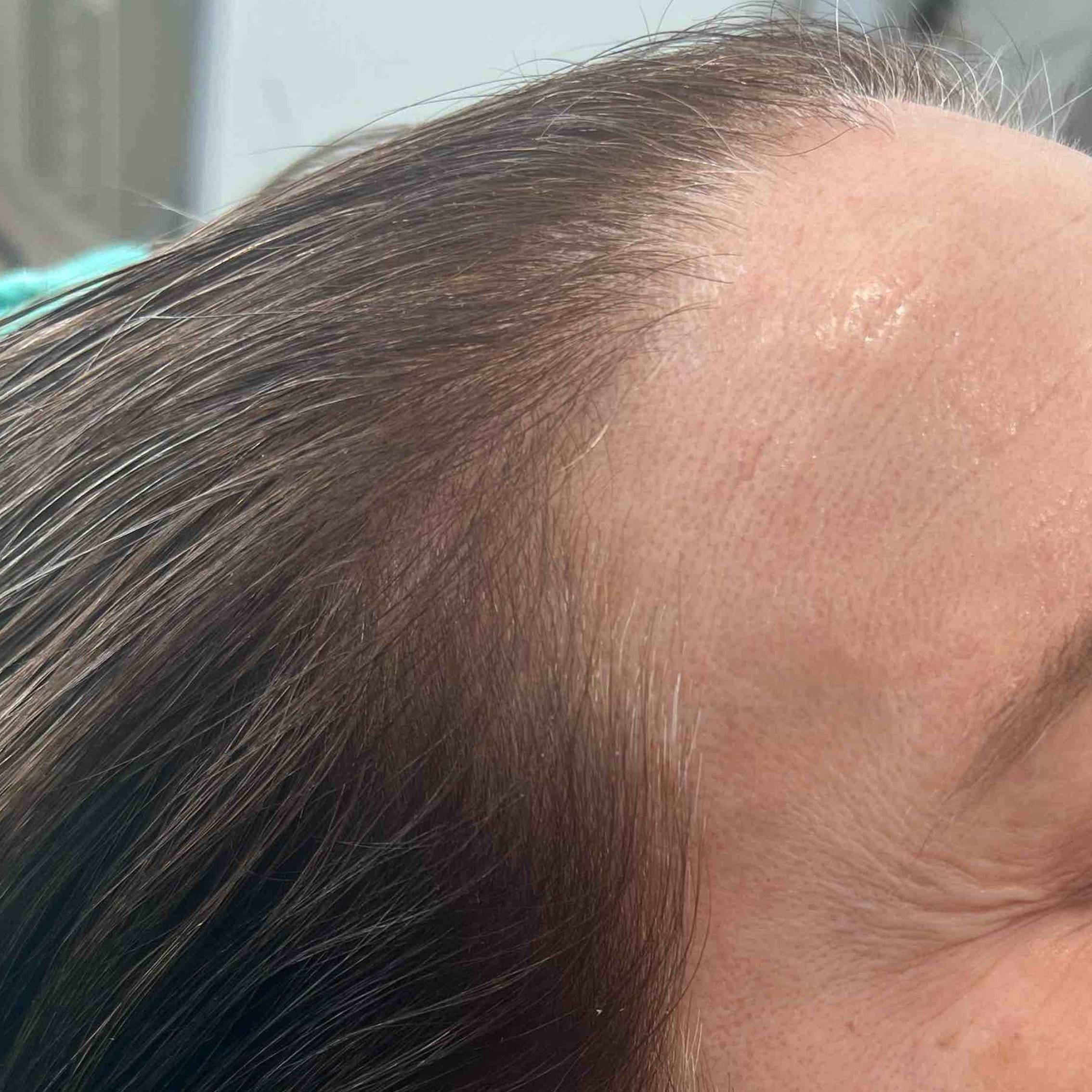 Hair Loss Before and After Case-14 After