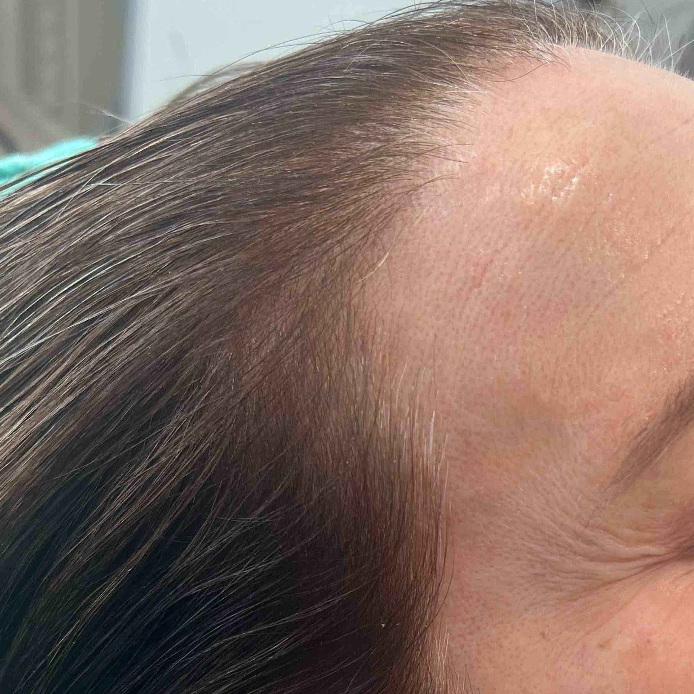 Platelet-Rich Plasma Before and After (1 treatment) Case-9 After