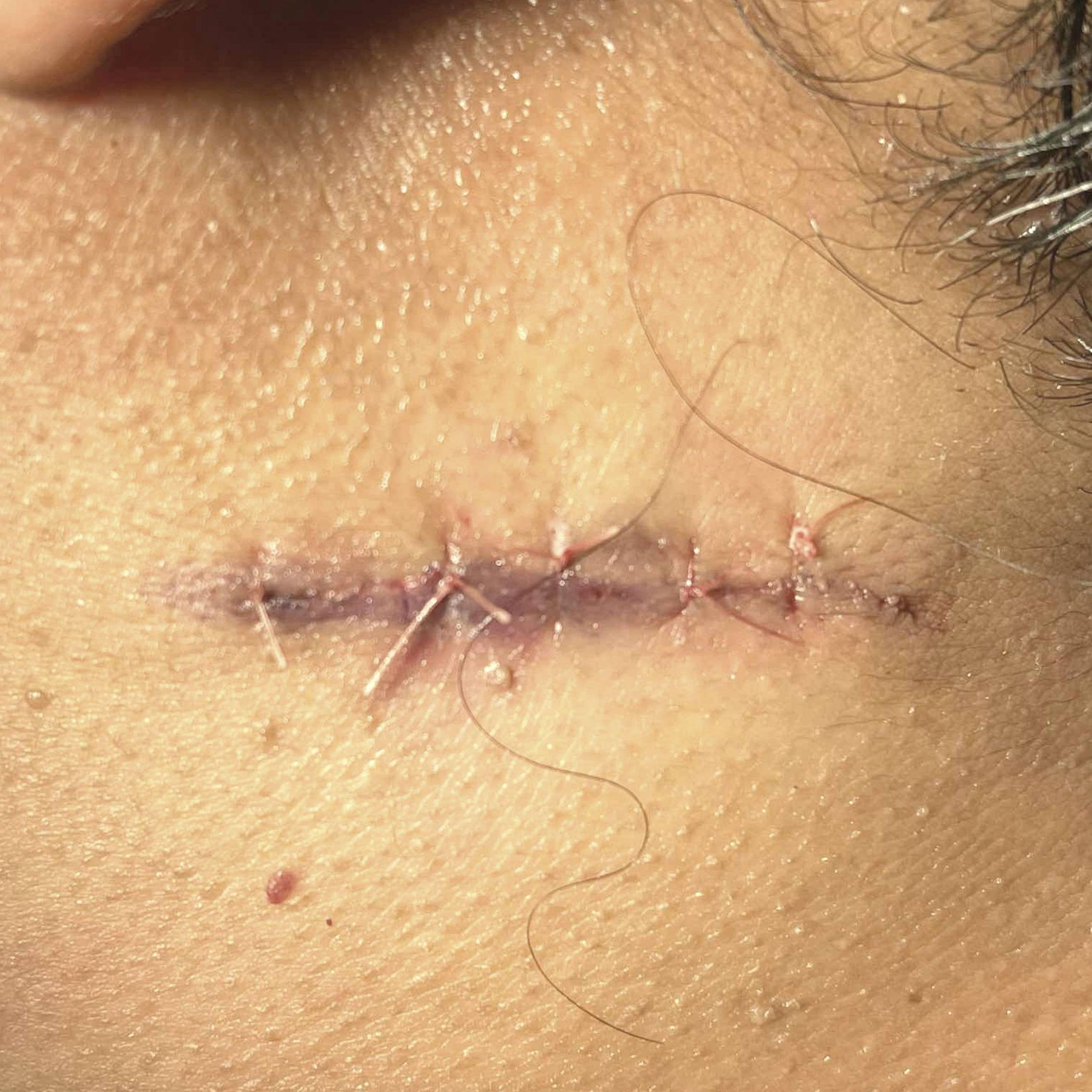 Cyst Removal Before and After Case-24 After