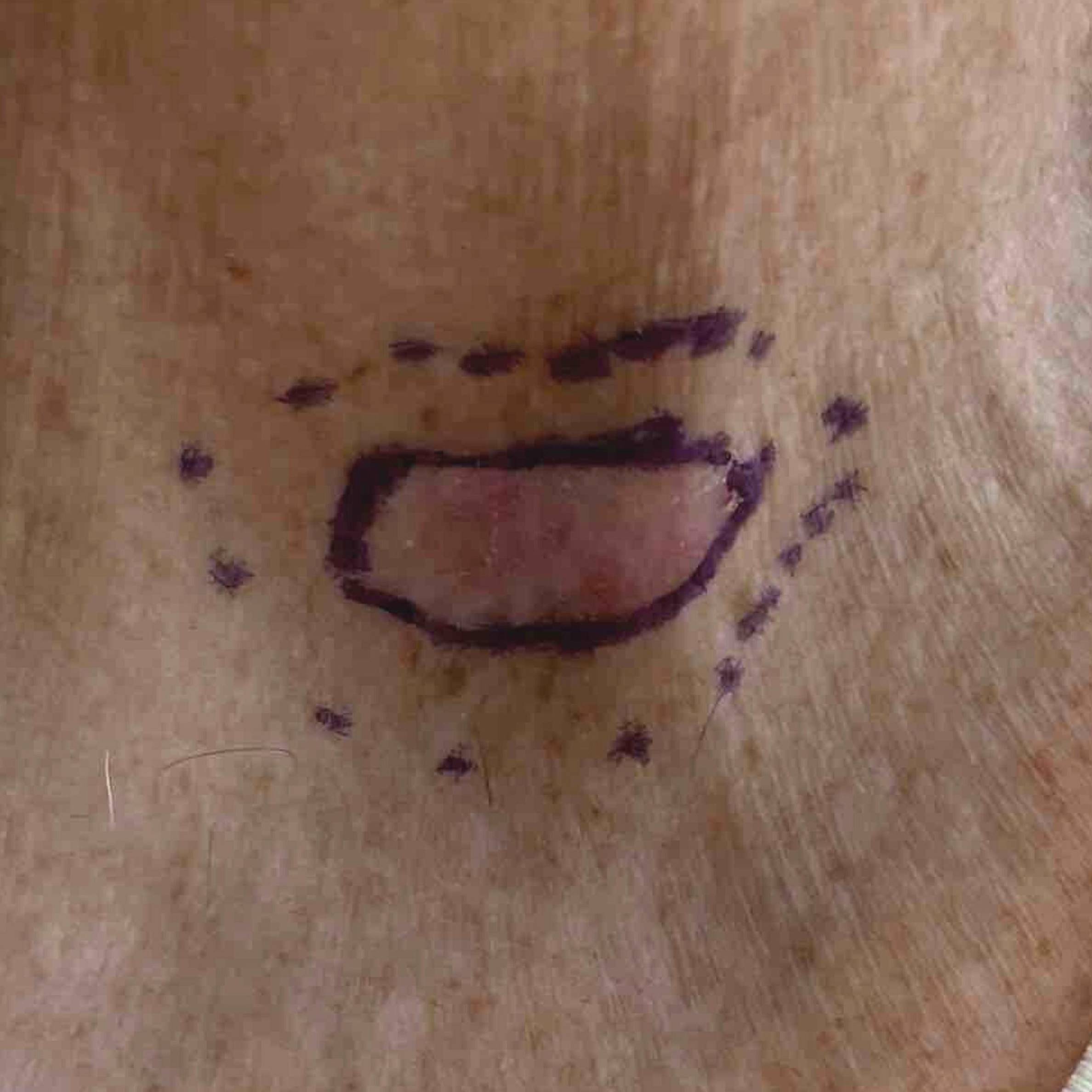 Skin Cancer (Excision) Case-80 Before