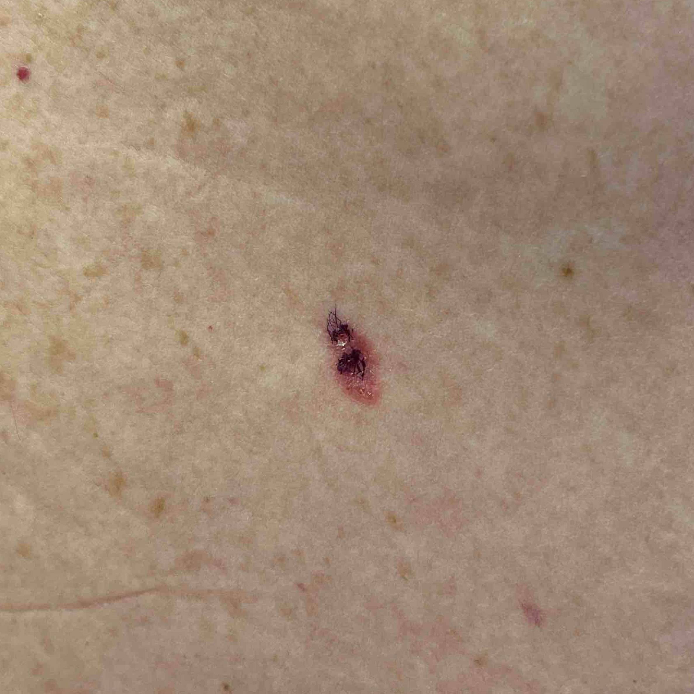 Skin Cancer (Excision) Case-81 Before