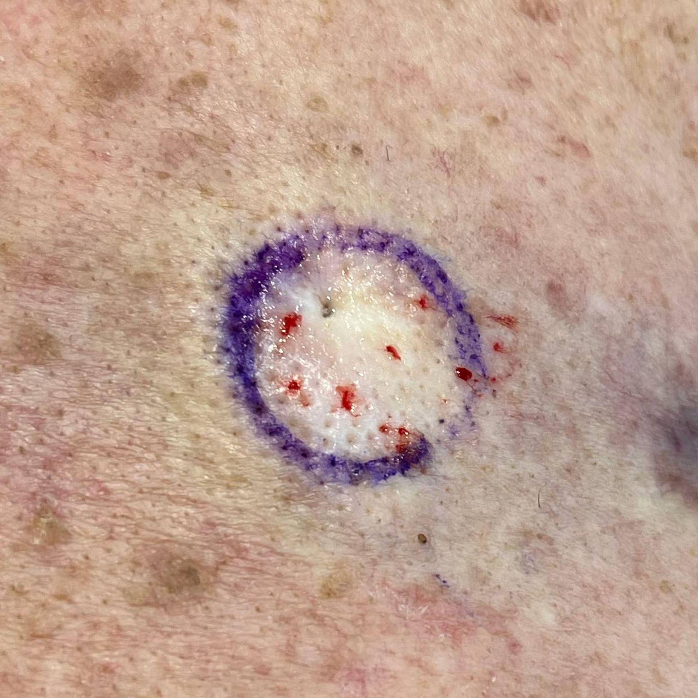 Cyst Removal Before and After Case-25 Before