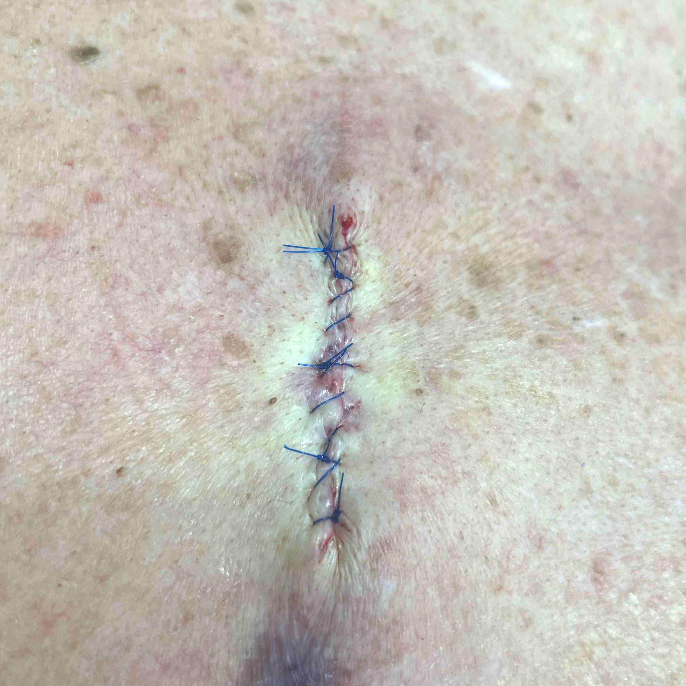 Cyst Removal Before and After Case-25 After