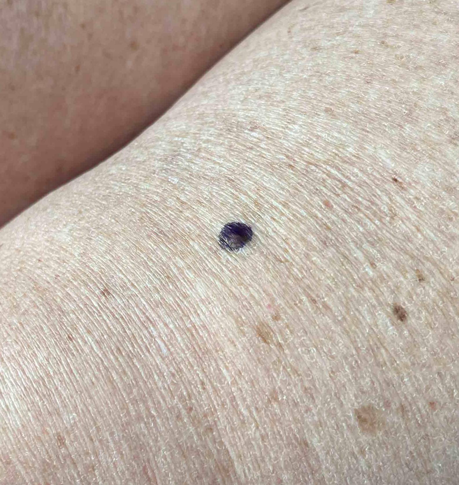Moles (Excision) Case-1 Before