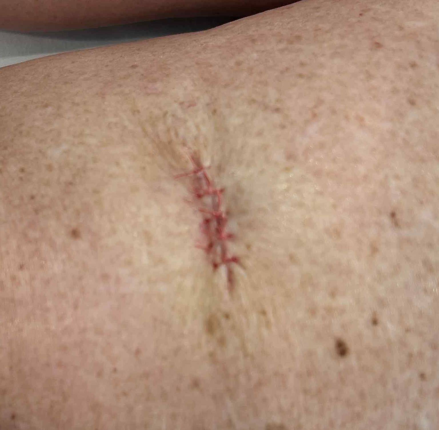 Moles (Excision) Case-1 After