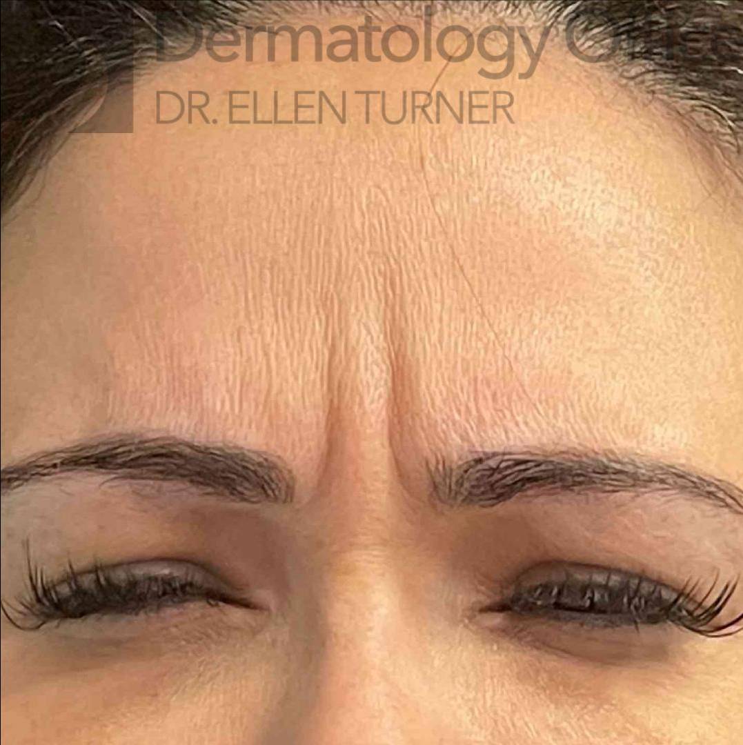 Botox (25 Units) Case-20 Before