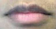 Juvederm (2 Syringes) Case 1 Before