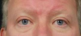 Restylane<sup>®</sup> Before and After Case 2 Before