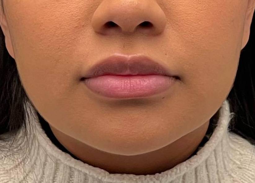 Juvederm (1 Syringe) Case-35 Before