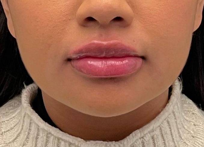 Juvederm (1 Syringe) Case-35 After