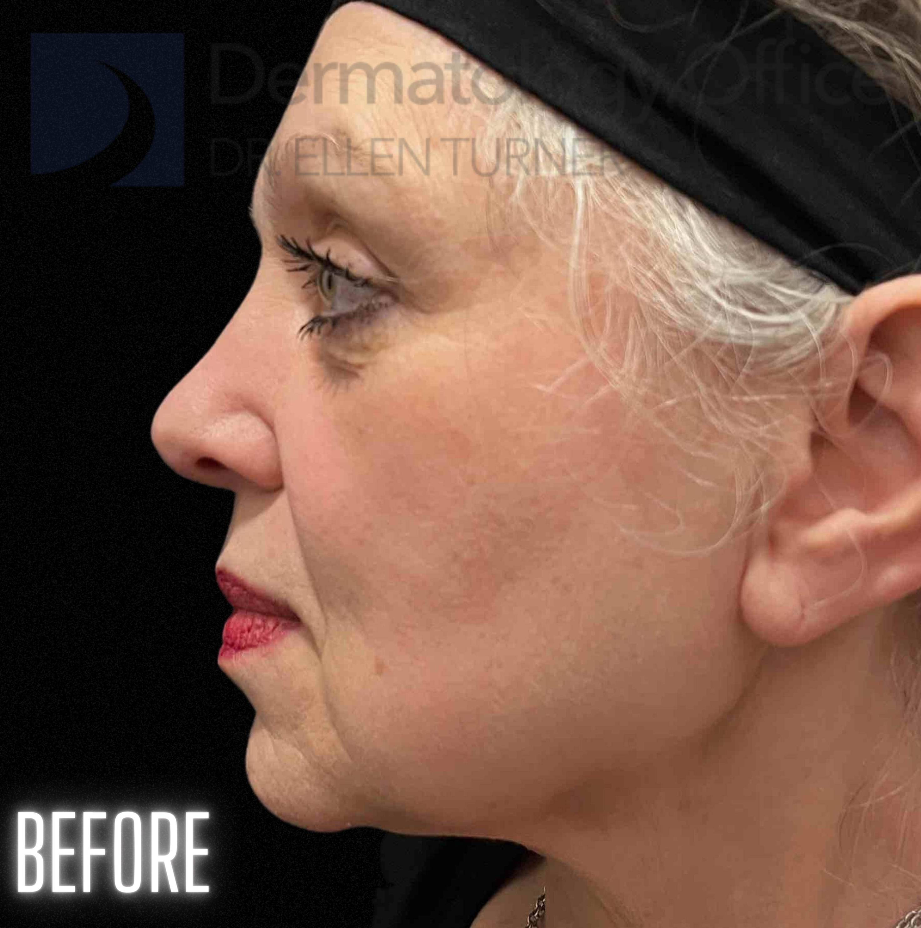 Snatch and Lift (4 treatments EMFACE and 4 syringes Volux XC) Before and After Case-1 Before